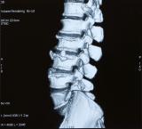 X-Ray of a spine